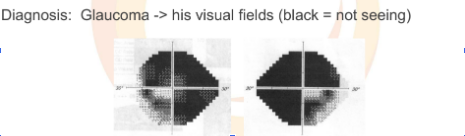 A scan shows how glaucoma affects vision. Image: Rosamond Gianutsos